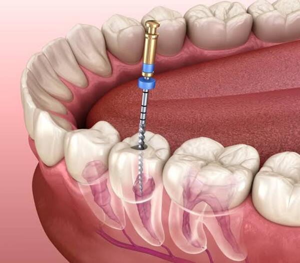 Canal_surgery