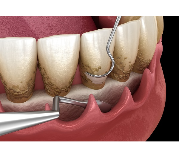 Periodontics