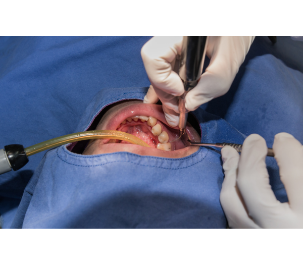 Oral Surgery
